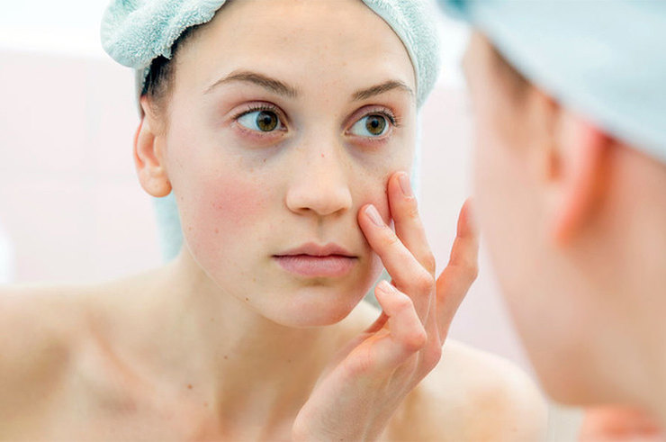 Āda šeit ir ļoti jutīga un plāna, tāpēc uz tās uzreiz kļūst redzamas visas negatīvās izmaiņas pietūkuma, tumšo loku un sasitumu veidā. ubrat-meshki-pod-glazami-v-domashnih-usloviyah_ (2)